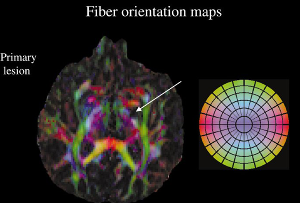 Water diffusion changes in wallerian degeneration and their dependence on white matter architecture. Pierpaoli C, Barnett A, Pajevic S, Chen R, Penix LR, Virta A, Basser P. (2001). Neuroimage. Jun;13(6 Pt 1):1174-85.